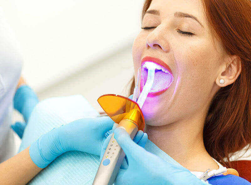 Dental Bonding Mississauga
