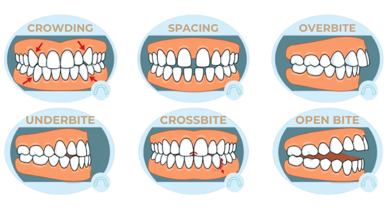 Illustration of bite conditions Invisalign can correct