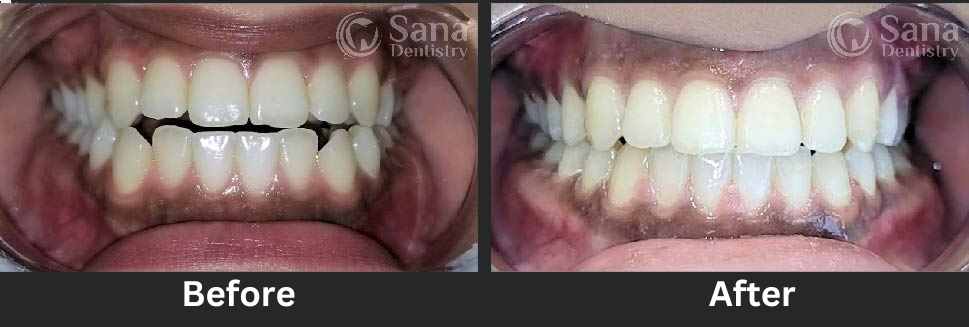 Before and After photos with Dental Braces