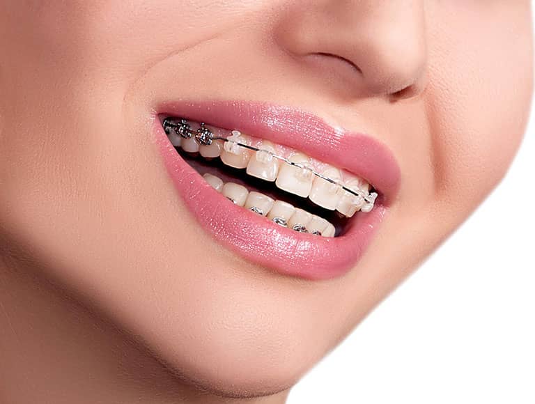 Affordable Braces in Mississauga