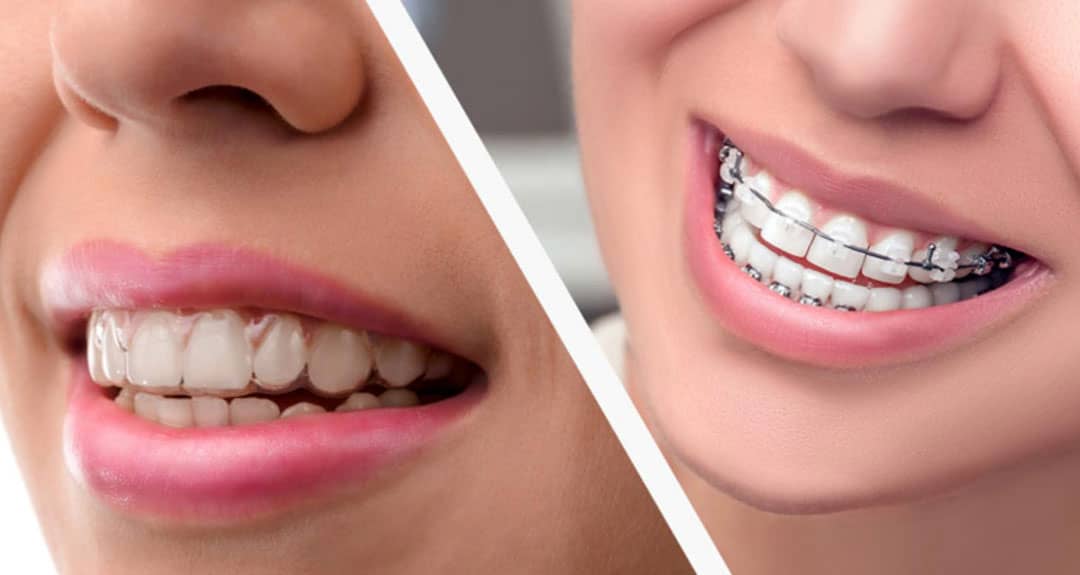 Braces Vs Invisalign Sana Dentistry Dentist Mississauga