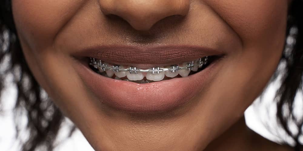 Dental Braces