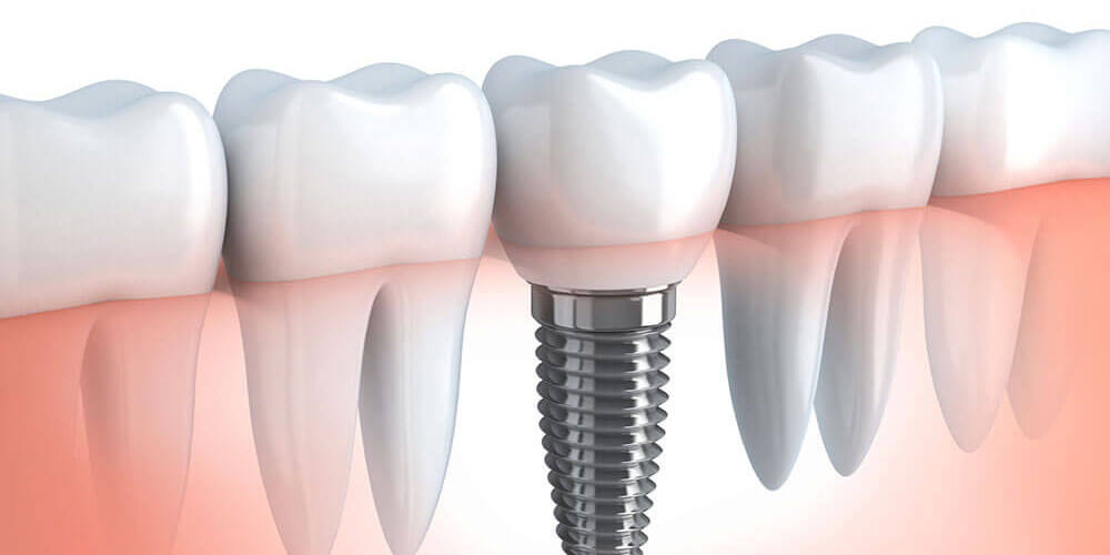 Dental Implants