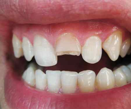 Broken or chipped tooth repair