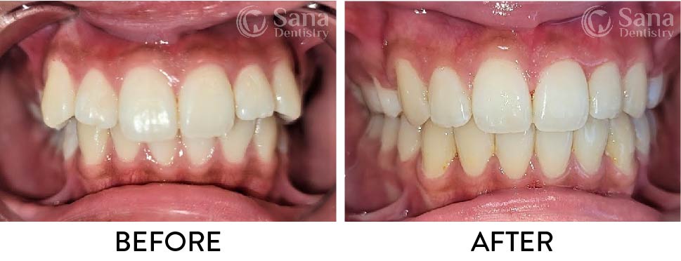 Before and After photos with Invisalign clear aligners
