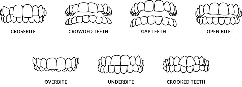 Invisalign Treatable cases - Dentist Mississauga