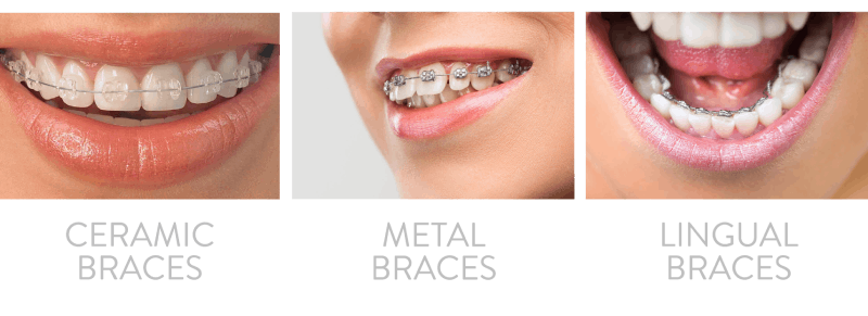 Types of Braces Types of Braces